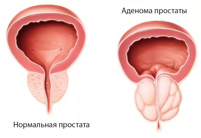 Нормальная простата/аденома простаты