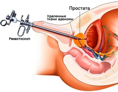 prostatita cu adenom de prostată)